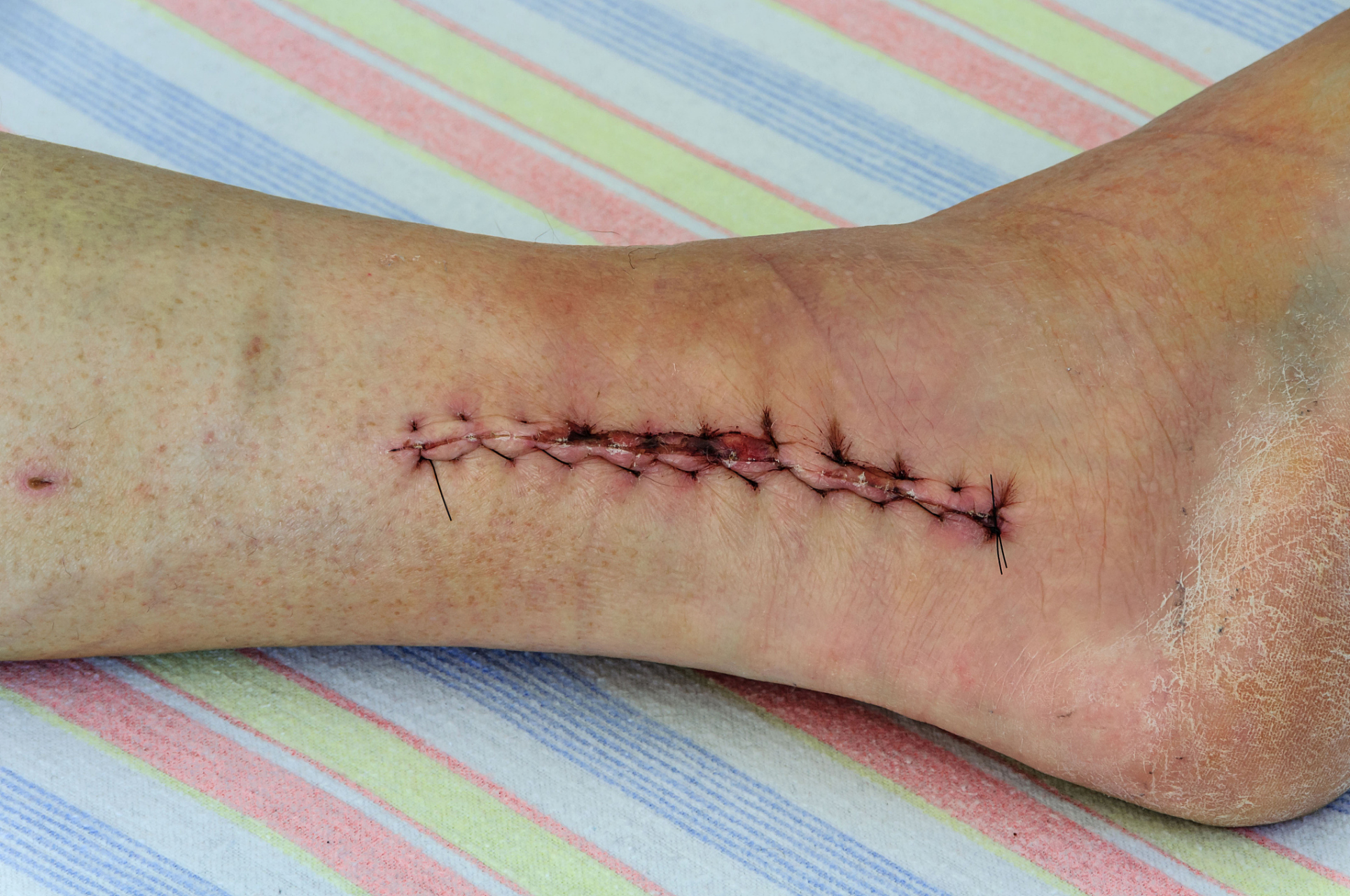 开云娱乐网站 -刺伤定义